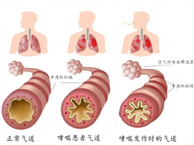 最新版气道管理指南